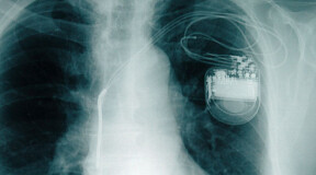 A new pacemaker equipped with artificial intelligence will combat cardiac insufficiency