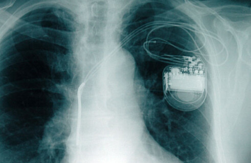 Новый кардиостимулятор с искусственным интеллектом поможет бороться с сердечной недостаточностью