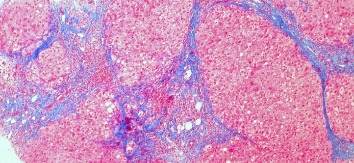 Ученые близки к созданию лекарства против цирроза печени