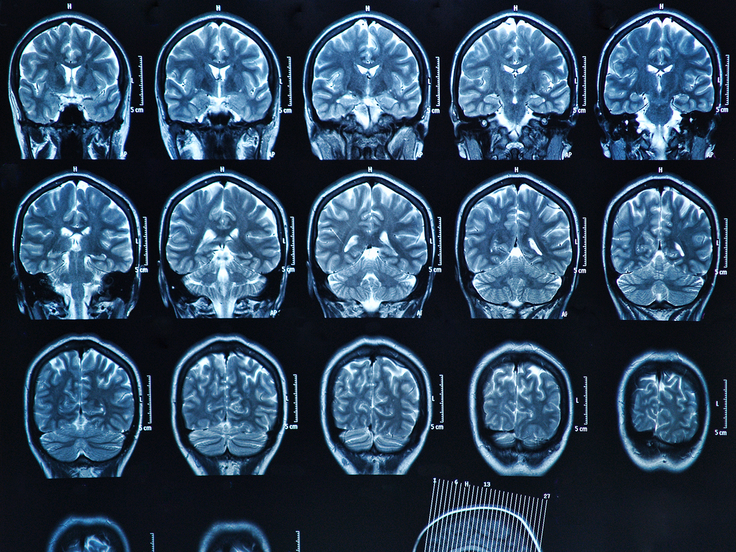 Кт головы стоя. Магнитно-резонансная томография головного мозга обзорная. Снимки кт мрт рентген. Микроинсульт мрт снимок. Кт томограмма головного мозга.