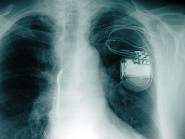 A New Pacemaker Equipped With Artificial Intelligence Will Combat 