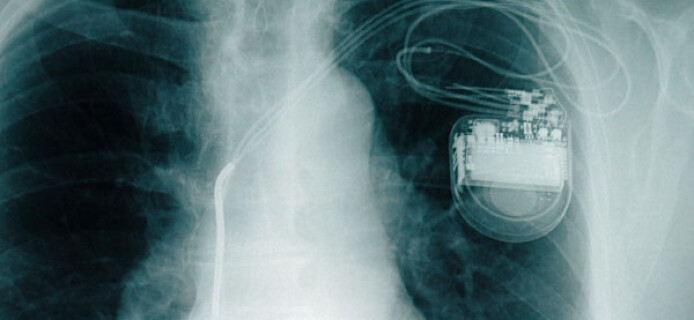 Новый кардиостимулятор с искусственным интеллектом поможет бороться с сердечной недостаточностью