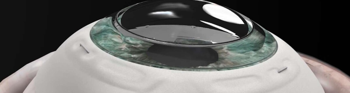 Israeli start-up CorNeat recovers the sight of a blind man