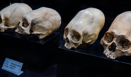 Mysterious Cone: Skull Found in Peru Puzzles Scientists