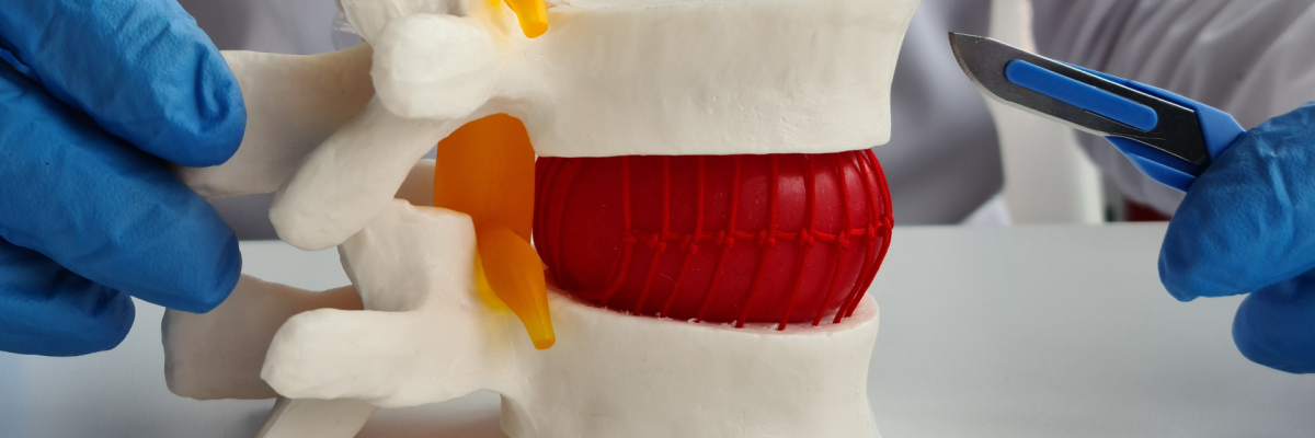 Neurosurgeons Implant First AI-Designed Personalized Spine Disc