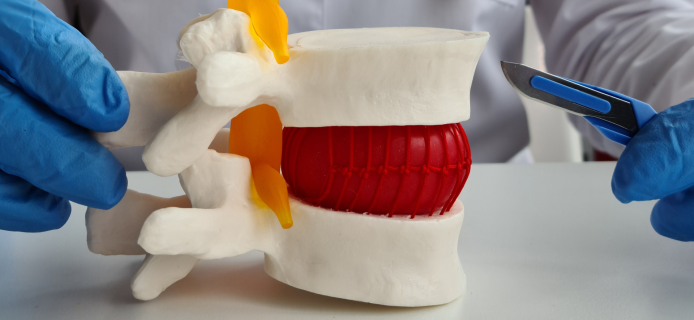Neurosurgeons Implant First AI-Designed Personalized Spine Disc